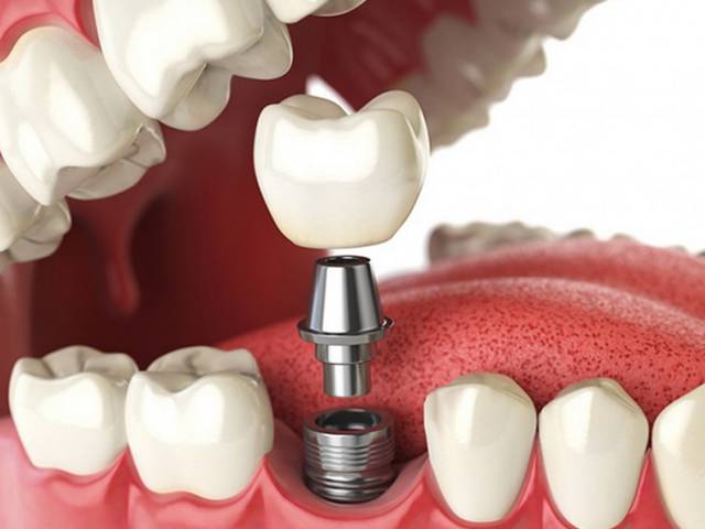 Dental Implant Turquie Side Antalya